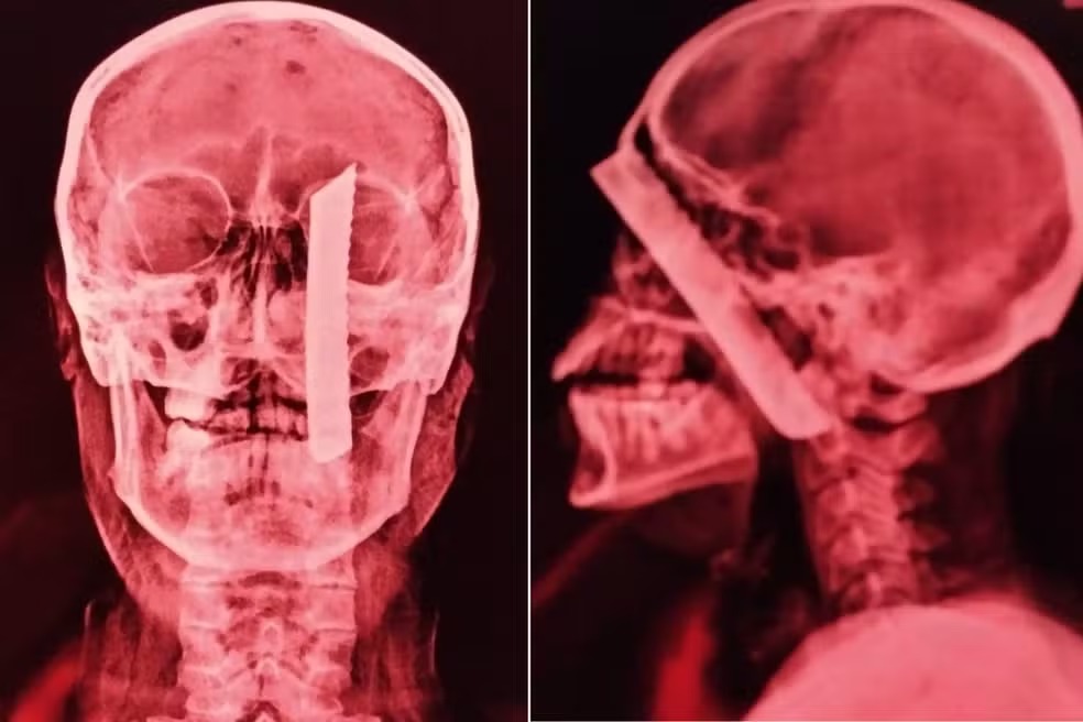 Homem crava faca na cabeça de inquilina após briga por aluguel 