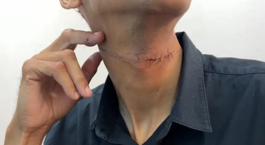Entregador sofre ferimento grave no pescoço ao ser atingido por linha chilena em Votuporanga
