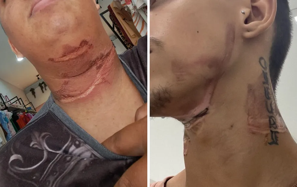 Entregadores têm pescoços atingidos por fios soltos em ruas de Fernandópolis: 'Senti queimando'